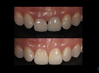歯茎の携帯修正とセラミック