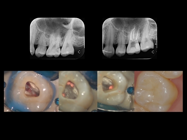 マイクロスコープによる歯の根の治療（歯内治療）と充填