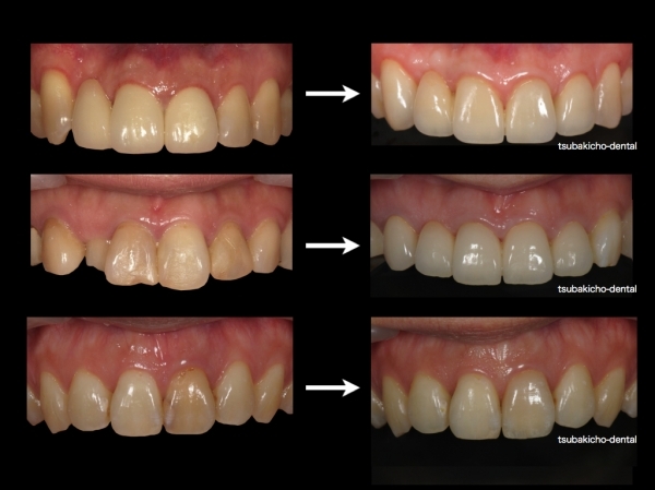前歯の治療　審美歯科治療